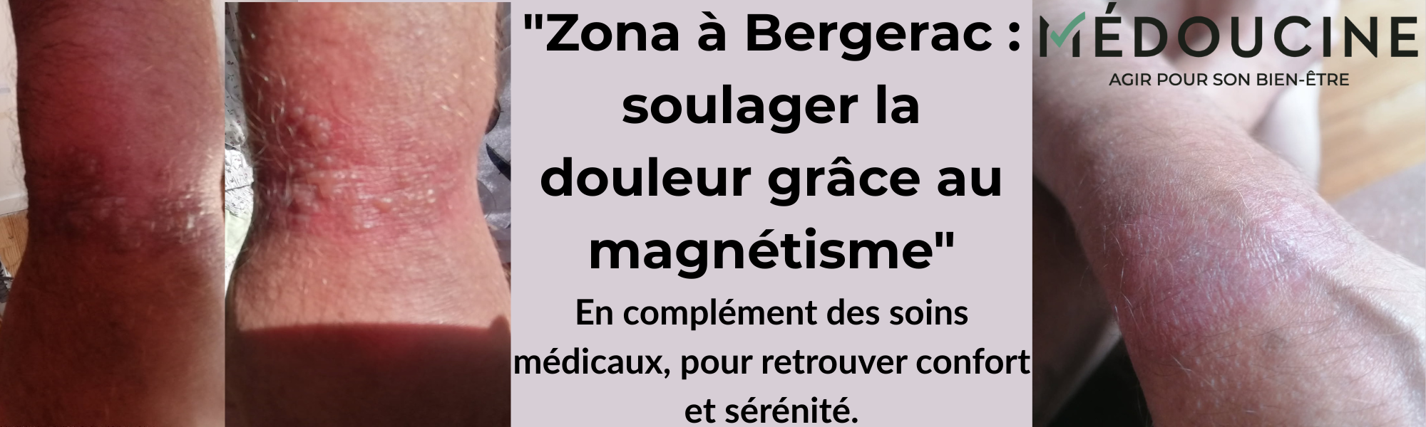 Zona à Bergerac : comment le magnétisme peut compléter les soins médicaux